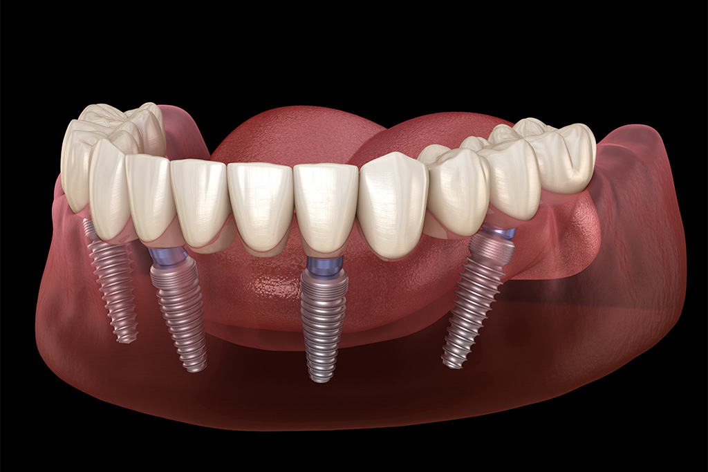インプラント治療