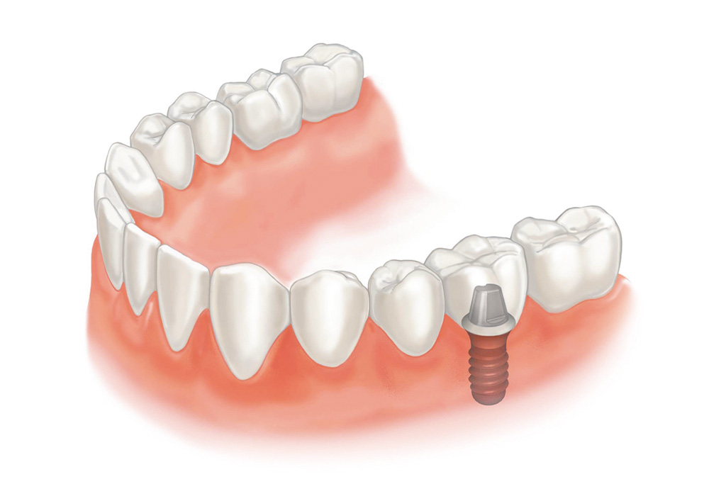 仮歯装着・噛み合わせ調整