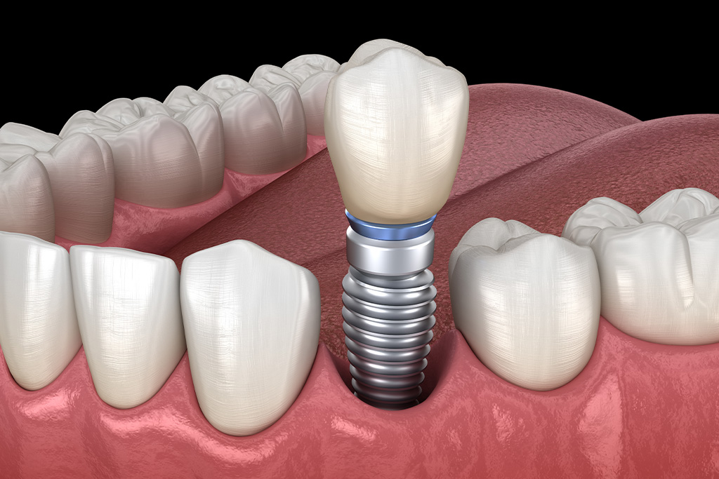 最終補綴（人工歯の装着）